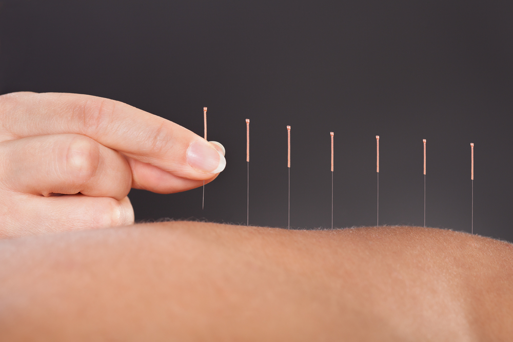 Co to jest akupunktura i co leczy?